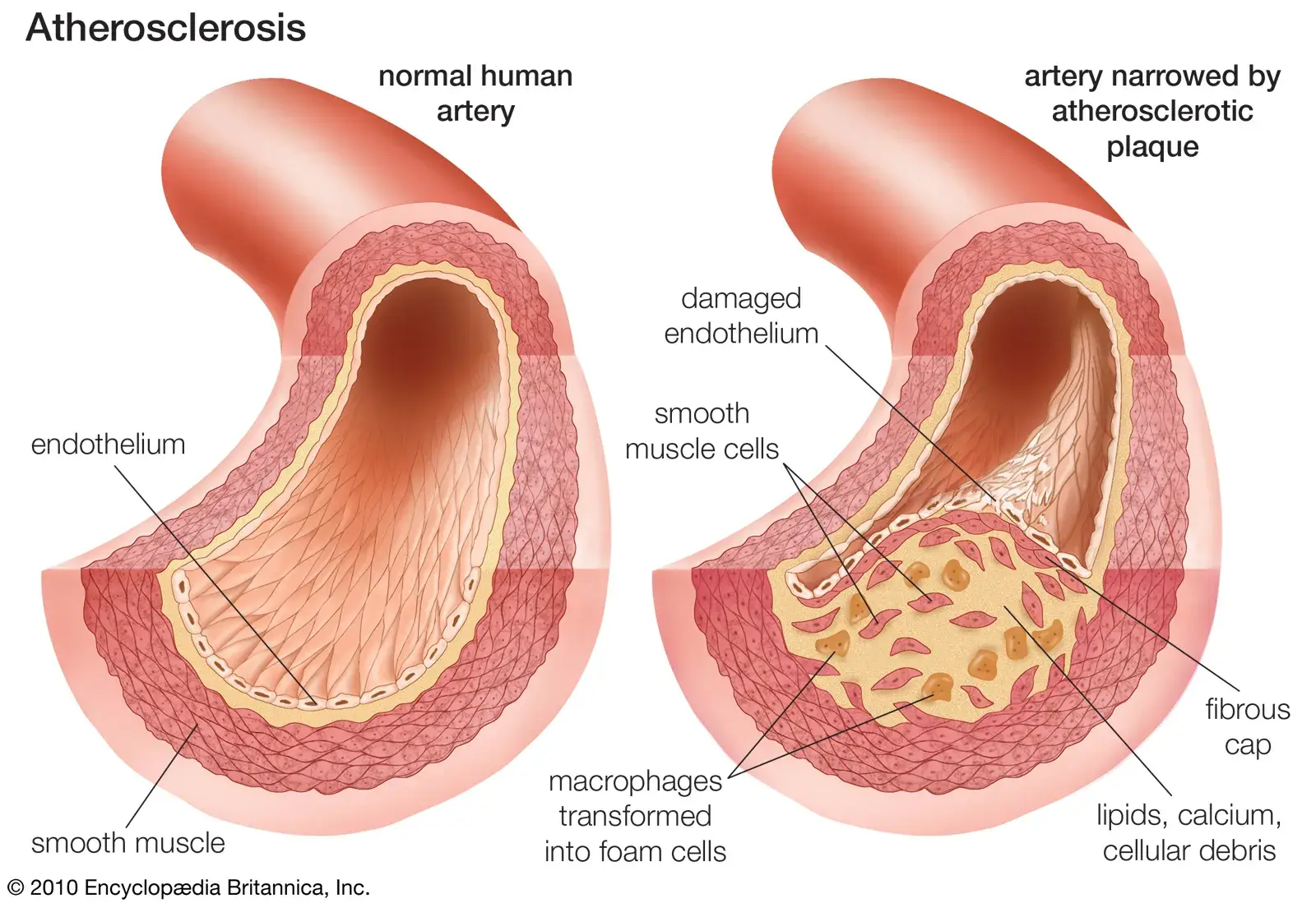 Atherosclerosis: hagyományos és alternatív gyógyászati megközelítések