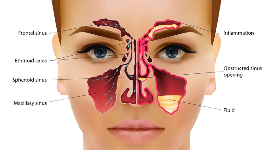 Krónikus sinusitis: alternatív terápiák a tünetek enyhítésére
