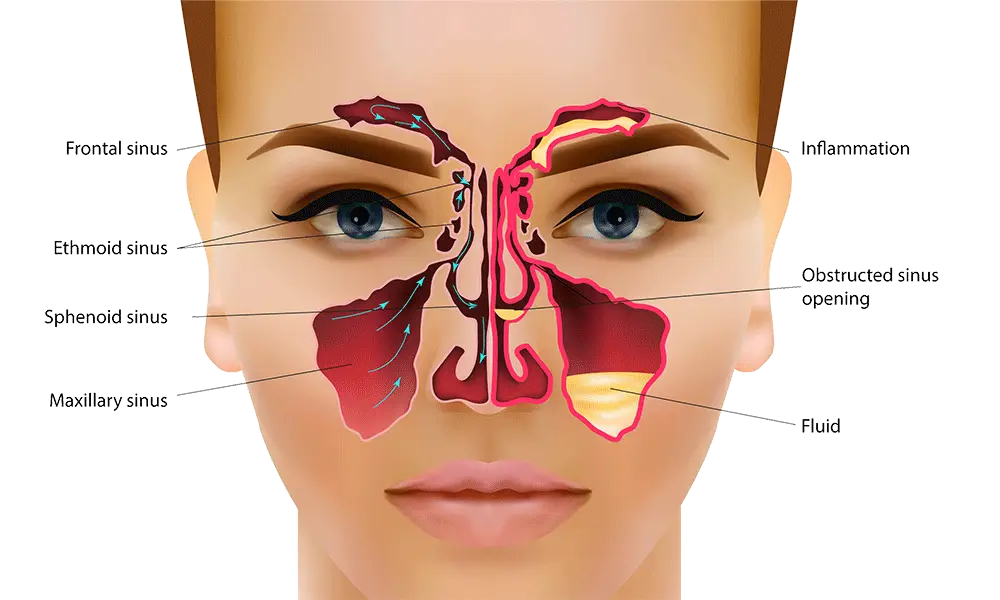 Krónikus sinusitis: alternatív terápiák a tünetek enyhítésére